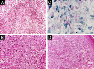 Histopathologic spectrum of leprosy. (A) Tuberculoid leprosy: well-formed epithelioid granulomas with a peripheral lymphocytic halo tracking neurovascular bundles in the dermis and extending into the subcutis (Hematoxylin & eosin, ×200; inset ×40). (B) Lepromatous leprosy: confluent infiltrate of macrophages with abundant vacuolated (“foamy”) cytoplasm (Hematoxylin & eosin, ×400). (C) Lepromatous leprosy: Fite–Faraco highlights numerous bacilli within macrophage cytoplasm (×1000). (D) Lepromatous leprosy: flattened epidermis separated from a macrophage-rich infiltrate by a subepidermal band of collagen (“grenz zone”) (Hematoxylin & eosin, ×100).