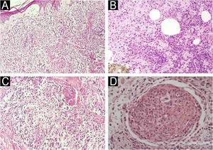 Leprosy reactions: type 1 vs. type 2. (A) Type 1 reaction: dermal edema separating components of the inflammatory infiltrate (Hematoxylin & eosin, ×40). (B) Type 2 reaction: neutrophil-rich exudation within a subcutaneous fat lobule on a macrophage-rich background; inset, anti-BCG immunohistochemistry highlights mycobacterial antigen within macrophage cytoplasm (Hematoxylin & eosin for main panel, ×200; inset ×200). (C) Type 1 reaction: epithelioid granuloma with edema-related dissociation of inflammatory cells (Hematoxylin & eosin, ×100). (D) Type 2 reaction: subcutaneous nerve permeated by neutrophilic exudate (Hematoxylin & eosin, ×200).