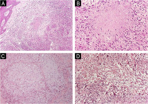 Differential diagnosis of granulomatous dermatoses. (A) Cutaneous tuberculosis: epithelioid granulomas, sometimes confluent, occupying the reticular dermis (Hematoxylin & eosin, ×100). (B) Cutaneous tuberculosis: fibrinoid necrosis within granulomas (Hematoxylin & eosin, ×200). (C) Sarcoidosis: compact (“naked”) epithelioid granulomas with minimal peripheral inflammation (Hematoxylin & eosin, ×200). (D) Granuloma annulare: palisading histiocytes surrounding foci of altered collagen; inset, Alcian blue highlights mucin within areas of collagen degeneration (Hematoxylin & eosin for main panel, ×200; inset ×200).