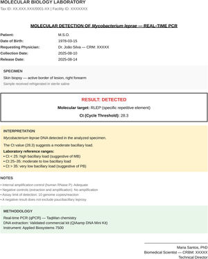 Example of a real-time quantitative PCR report for Mycobacterium leprae (RLEP target) from a biopsy of the active edge of a lesion, showing a positive result (Ct 28.3). Ct is inversely proportional to bacillary load; in this laboratory, values < 25 indicate high load (multibacillary forms), 25–35 moderate load, and > 35 low load (paucibacillary forms). Valid internal and negative controls confirm assay quality.