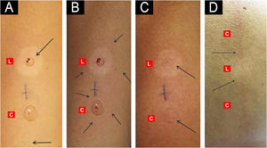 Exogenous (A–C) and endogenous (D) histamine tests. (A) Erythema confined to the puncture site at 15–20 seconds, present in both Lesion (L) and Control (C) skin. (B) Axon-reflex erythema (flare) at 30–60 seconds, present only in Control (C) skin and abolished in the Lesion (L). (C) Wheal formation at 2–3 minutes, visible in both areas (L and C). (D) Dermographism after a linear mechanical stimulus, observed in Control (C) skin and absent within the Lesion (L).