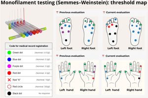 Semmes-Weinstein monofilament testing: bilateral mapping of tactile thresholds in the hands and feet. Each dot records the smallest filament perceived at the tested site; colors follow the key shown. Comparing the “prior assessment” with the “current assessment” allows recognition of clinically meaningful worsening ‒ the need for heavier filaments at ≥ 2 points within the same territory, or the emergence of non-responsive areas ‒ consistent with progressive neuritis in the right ulnar and left posterior tibial nerves.