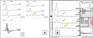 Electrodiagnostic findings in demyelinating neuropathy. (A) Bilateral ulnar motor conduction. Left: Normal right ulnar nerve. Right: Left ulnar nerve with partial conduction block (>50% CMAP reduction above elbow, yellow arrow). (B) Right tibial nerve at ankle. A1/B1: Medial plantar; C1/D1: Lateral plantar nerve. Progressive temporal dispersion evident in B1/D1 (red arrows). Reduced velocities across the tarsal tunnel (19.3‒19.0 m/s, circled). Conduction block and temporal dispersion characterize segmental demyelination.