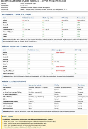 Example electrodiagnostic report in leprosy. Ulnar nerve with reduced motor conduction velocity (35 m/s; normal > 50 m/s) and absent sensory response; common fibular nerve with partial conduction block at the fibular head; median and tibial nerves preserved. Pattern consistent with asymmetric multiple mononeuropathy.