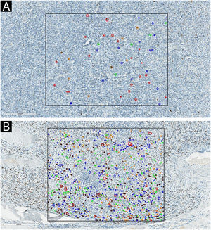 Examples of the one-square-millimeter demarcated area and the classification of Ki-67 staining patterns through colored circles. A case of “Al” group in image A and “De” group in image B. Blue circle: NP1. Green circle: NP2. Orange circle: NP3. Brown circle: NP4. Red circle: NP5.