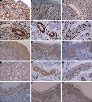 JAK1 expression in MF patients. (A) Strong nuclear expression of JAK1 in epidermal and dermal infiltrate, IRS = 12 (Immunostain for JAK1 × 200). (B) Moderate nuclear expression of JAK1 in epidermal and dermal infiltrate, IRS = 6 (Immunostain for JAK1 × 200). (C) Nuclear expression of JAK1 in endothelial cells in the wall of blood vessels perivascular lymphocytes. (D) Strong nuclear expression of JAk1 in the wall of hair follicles and perifollicular lymphocytic infiltrate. (E) Positive nuclear expression of JAK1 in eccrine glands and ducts. (F) Positive nuclear expression of JAK1 in nerve fibers. JAK3 expression in MF patients. (G) Strong cytoplasmic expression of JAK3 in epidermal and dermal infiltrate, IRS = 9 (Immunostain for JAK3 × 200). (H) Moderate cytoplasmic expression of JAK3 in epidermal and dermal infiltrate, IRS = 6 (Immunostain for JAK3 × 200). (I) Mild cytoplasmic expression of JAK3 in epidermal and dermal infiltrate, IRS = 3 (Immunostain for JAK3 × 200). (J) Numerous dilated blood vessels with positive staining of JAK3 in endothelial cells in the wall. (K) Positive cytoplasmic expression of JAK3 in eccrine gland and ducts. (L) Positive JAK3 in nerve fibers (cytoplasmic expression). JAK1 & JAK3 expression in normal controls. (M) Mild nuclear expression of JAK1, IRS = 2 (Immunostain for JAK1 × 200). (N) Mild cytoplasmic expression of JAK3, IRS = 3. Higher intensity of expression is noted in the basal cell layer of epidermis. (O) Note the weak positive staining in the endothelial lining of the dermal blood vessels.