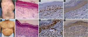 JAK1 & JAK3 expression in Patch Stage Classic MF. (A) Classic MF with multiple scaly atrophic erythematous patches on back. (B) Hematoxylin & eosin showing perivascular infiltrate of atypical lymphocytes in the dermis and basilar epidermotropism in the epidermis. (Hematoxylin & eosin, ×200). (C) Moderate nuclear expression of JAK1 in epidermal and dermal infiltrate. IRS = 6, intensity of staining = 3, Percentage of positive cells = 2, (Immunostain for JAK1 × 200). (D) Moderate cytoplasmic expression of JAK3 in epidermal and dermal infiltrate. IRS = 6 (Immunostain for JAK3 × 200). (E) Classic MF with disseminated erythematous, slightly atrophic scaly patches on trunk. (F) Hematoxylin and eosin showing basilar, pagetoid epidermotropism and dermal atypical lymphocytes (Hematoxylin & eosin, ×200). (G) Strong nuclear expression of JAK1 in epidermal and dermal infiltrate. IRS = 9 (Immunostain for JAK1 × 200). (H) Moderate cytoplasmic expression of JAK3 in epidermal and dermal infiltrate. IRS = 4 (Immunostain JAK3 × 200).