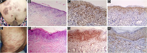 JAK1 & JAK3 expression in Plaque Stage Classic MF. (A) Classic MF with multiple erythematous brownish scaly plaques. (B) Hematoxylin & eosin showing extensive infiltrate of atypical lymphocytes in the upper dermis. Clear epidermotropism and pautrier microabcess are seen. (Hematoxylin & eosin, ×200). (C) Strong nuclear expression of JAK1 in epidermal and dermal infiltrate, IRS = 12 (Immunostain for JAK1 × 200). (D) Moderate cytoplasmic expression of JAK3 in epidermal and dermal infiltrate, IRS = 8 (Immunostain for JAK3 × 200). (E) Classic MF with multiple reddish brownish patches and plaques. (F) Hematoxylin and eosin showing plaque stage MF with heavy epidermotropism in the epidermis, and band like and perivascular infiltrate of atypical lymphocytes in the dermis. (Hematoxylin & eosin, ×40). (G) Strong nuclear expression of JAK1 in epidermal and dermal infiltrate, IRS = 9 (Immunostain for JAK1 × 200). (H) Moderate cytoplasmic expression of JAK3 in epidermal and dermal infiltrate, IRS = 6 (Immunostain for JAK3 × 200).