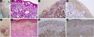 JAK1 & JAK3 expression in Tumor Stage Classic MF. (A) Tumor stage MF with multiple nodules, more than 1 cm in diameter. Some of these nodules arise on top of plaques of MF. (B) Hematoxylin & eosin showing dense infiltrate of atypical lymphocytes in the papillary and reticular dermis. Extensive epidermotropism and Pautrier microabcesses are seen in the epidermis (Hematoxylin & eosin, ×200). (C) Strong nuclear expression of JAK1 in epidermal atypical lymphocytes in Pautrier microabcesses and dermal infiltrate, IRS = 12 (Immunostain for JAK1 × 200). (D) Moderate cytoplasmic expression of JAK3 in epidermal and dermal infiltrate, IRS = 6 (Immunostain for JAK3 × 200). (E) Tumor stage of MF with large, ulcerated nodules on right side of chest. (F) Hematoxylin & eosin, showing heavy infiltrate of atypical lymphocytes in the papillary and reticular dermis with no epidermotropism (Hematoxylin & eosin, ×200). (G) Strong nuclear expression of JAK1 in epidermal and dermal infiltrate, IRS = 12. Note the weak staining in epidermis (no epidermotropism) (Immunostain for JAK1 × 200). (H) Strong cytoplasmic expression of JAK3 in epidermal and dermal infiltrate, IRS = 12 (Immunostain for JAK3 × 400).