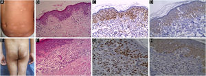 JAK1 & JAK3 expression in Hypopigmented MF. (A) Hypopigmented MF with ill-defined hypopigmented macules and patches. (B) Hematoxylin & eosin, showing epidermotropism and atypical lymphocytes in upper dermis. (Hematoxylin & eosin, ×200). (C) Strong nuclear expression of JAK1 in epidermal and dermal infiltrate, IRS = 9 (Immunostain for JAK1 × 200). (D) Mild cytoplasmic expression of JAK3 in epidermal infiltrate, IRS = 3 (Immunostain for JAK3 × 200). (E) Hypopigmented MF with hypopigmented slightly atrophic patches on back. (F) Hematoxylin & eosin showing band like infiltrate of atypical lymphocytes and epidermotropism (Hematoxylin & eosin, ×200). (G) Moderate nuclear expression of JAK1 in epidermal and dermal infiltrate, IRS = 6 (Immunostain for JAK1 × 200). (H) Moderate cytoplasmic expression of JAK3 in epidermal and dermal infiltrate, IRS = 6 (Immunostain for JAK3 × 200).