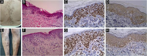 JAK1 & JAK3 expression in Hyperpigmented MF. (A) Hyperpigmented MF with scattered hyperpigmented patches with ill-defined irregular border, some of them show slight atrophy on trunk. (B) Hematoxylin & eosin showing epidermotropism of atypical lymphocytes, basilar hyperpigmentation and melanin incontinence in the dermis (Hematoxylin & eosin, ×200). (C) Moderate nuclear expression of JAK1 in epidermal cells and dermal infiltrate, IRS = 6 (Immunostain for JAK1, × 200). (D) Mild cytoplasmic expression of JAK3 in epidermal and dermal infiltrate, IRS = 3 (Immunostain for JAK3, × 200). (E) Hyperpigmented MF with brownish scaly patches on lower limbs. (F) Hematoxylin and eosin showing dermal infiltrate of atypical lymphocytes in the papillary dermis, perivascular lymphocytes and epidermotropism. Melanophages are present in the upper dermis (Hematoxylin & eosin, ×200). (G) Strong nuclear expression of JAK1 in epidermal and dermal infiltrate, IRS = 9 (Immunostain for JAK1, × 200). (H) Moderate cytoplasmic expression of JAK3 in epidermal and dermal infiltrate, IRS = 6 (Immunostain for JAK3, × 200).