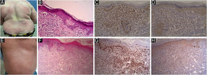 JAK1 & JAK3 expression in Poikilodermatous MF. (A) Poikilodermatous MF with pigmented scaly network and telangiectasia. (B) Hematoxylin & eosin, showing extensive epidermotropism of atypical lymphocytes in the epidermis. Numerous blood vessels and atypical lymphocytes are seen in the dermis (Hematoxylin & eosin, ×200). (C) Moderate nuclear expression of JAK1 in epidermal and dermal infiltrate, IRS = 6 (Immunostain for JAK1, × 200). (D) Moderate cytoplasmic expression of JAK3 in epidermal and dermal infiltrate, IRS = 4 (Immunostain for JAK3, × 200). JAK1 & JAK3 expression in Erythrodermic MF. (E) Erythrodermic MF with generalized scaling and erythema. (F) Hematoxylin and eosin showing basilar epidermotropism in the epidermis, infiltrate of atypical lymphocytes and numerous dilated blood vessels in the dermis (Hematoxylin & eosin, ×200). (G) Strong nuclear expression of JAK1 in epidermal and dermal infiltrate, IRS = 9 (Immunostain for JAK1, × 200). (H) Moderate cytoplasmic expression of JAK3 in epidermal and dermal infiltrate, IRS = 6 (Immunostain for JAK3, × 200).