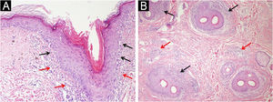 Lichen planopilaris. (A) Vacuolar degeneration of infundibulum basal cells (black arrows) and dermal lichenoid infiltrate (red arrows) (vertical section, Hematoxylin & eosin, ×200). (B) Perifollicular lichenoid inflammation (black arrows) and interfollicular interstitial/perivascular inflammation (red arrows) (transverse section, Hematoxylin & eosin, ×100).
