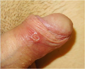 Circular ulcer with raised edge at the inner foreskin.