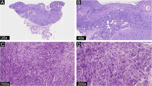 Light microscopy – (A) Hematoxylin & eosin (Hematoxylin & eosin, ×20) image of the ulcerated dermal lesion with multinodular architecture and poorly defined borders. (B) (Hematoxylin & eosin, ×40) Prominent polymorphonuclear infiltrate; vascular structures with interspersed prominent endothelial (tack) cells, and areas of central fibrosis. (C‒D) (Hematoxylin & eosin, ×100, ×200) Higher power section of atypical spindle and epithelioid cells, some of them with dense eosinophilic cytoplasm and eccentric nuclei, resembling rhabdomyoblasts.