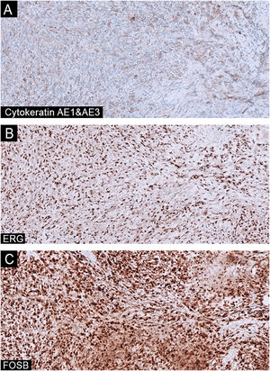 Imunnohistochemistry -The tumor cells showed weak and diffuse positivity for Cytokeratin AE1/AE3 (A, ×100), moderate and diffuse positivity for ERG (B, ×100), and strong and diffuse positivity for FOSB (C, ×100).