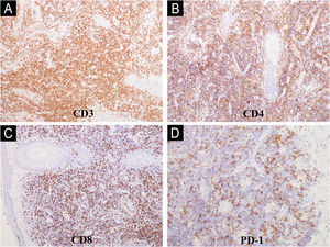 Immunohistochemical markers of the primary cutaneous CD4+ small/medium T-cell lymphoproliferative disorder. The lymphoid cells mostly show the CD3+, CD4+, CD8+ and PD-1 phenotype (A, B, C and D respectively).