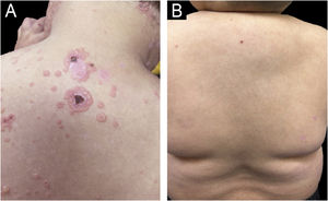 (A) Lesions grouped in an annular “string of pearls” pattern on the back and neck. (B) Residual lesions following the first cycle of rituximab.