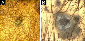 Case 1. (A) Asymmetric, poorly defined papule on the right parietal region. (B) Dermoscopy showing blue-gray pigmentation with white shiny linear streaks (20× magnification).