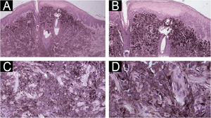 Case 1 ‒ Histopathology. (A‒B) Diffuse proliferation of neoplastic cells with abundant cytoplasm and coarse melanin pigmentation, infiltrating the full thickness of the dermis and focally extending into the hypodermis (Hematoxylin & eosin, ×40, ×100). (C‒D) The nuclei are round to oval, hyperchromatic, and exhibit prominent central nucleoli (Hematoxylin & eosin, ×200, ×400).