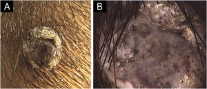 Case 2. (A) Dark, pedunculated, 1 cm tumor on the right occipital region. (B) Dermoscopy showing dark pigmentation, adherent scales, ulceration, polymorphous vessels, and white shiny streaks (20× magnification).
