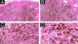 Case 2 ‒ Histopathology. (A‒B) Diffuse proliferation of epithelioid cells, some containing melanin pigmentation, infiltrating the papillary dermis in blocks and as isolated cells. A lymphocytic inflammatory infiltrate and melanophages are also noted in the dermis (Hematoxylin & eosin, ×40, ×100). (C‒D) The nuclei are hyperchromatic, polymorphic, and exhibit prominent nucleoli (Hematoxylin & eosin, ×200, ×400).