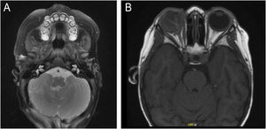 (A) MRI showing hypoplasia of the right cerebellum (case 1). (B) MRI showing right retinoblastoma (case 2).