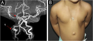 (A) MRA showing tortuous: 1) Right internal carotid artery and 2) right posterior cerebral artery and (B) Sternal aplasia and thoracic cutis aplasia (case 3).