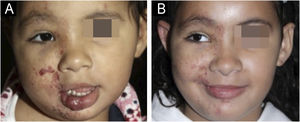 Female patient with right hemiface infantile hemangioma and PHACE syndrome (case 4). (A) At 2-years and 4-months of age after 17-months of treatment with oral propranolol (2 mg/kg/day). (B) At 7-years and 1-month of age, showing good response of the infantile hemangioma after 17-months of treatment with oral propranolol (2 mg/kg/day) and 2-years and 4-months of topical timolol.