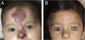 Female patient with frontonasal infantile hemangioma and PHACE syndrome (case 5). (A) At 1-month and 29-day of age. (B) At 1-year and 6-months of age, showing good response of the infantile hemangioma after 16-months of treatment with oral propranolol (2 mg/kg/day).