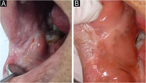 Clinical features of oral paracoccidioidomycosis. (A) Intraoral view showing an ulcerated, moriform lesion with infiltrative borders on the right buccal mucosa contiguous to the labial commissure, measuring approximately 3 × 3 cm. (B) Clinical follow-up image after 24-months demonstrating cicatricial fibrosis and no evidence of recurrence.