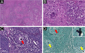 Histopathological features of oral paracoccidioidomycosis. (A) Low-power view showing pseudoepitheliomatous hyperplasia with underlying chronic inflammatory infiltrate. (B) Higher magnification demonstrating multinucleated giant cells, lymphocytes, and plasma cells. (C) Periodic acid-Schiff (PAS) and (D) Grocott-Gomori Methenamine Silver (GMS) staining illustrating multiple budding yeasts of the Paracoccidioides spp. in the profile of the “pilot wheel” arrangement (yellow arrows; inset) or round structures (red arrows) (hematoxylin and eosin staining: 40× and 200× magnification; PAS and GMS: 200× magnification).