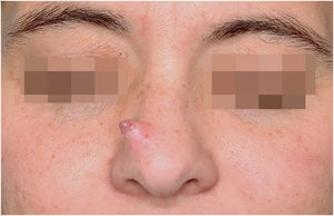 Clinical image of exophytic tumor with sessile, pinkish erythematous, well-demarcated base on the right lateral nasal slope.