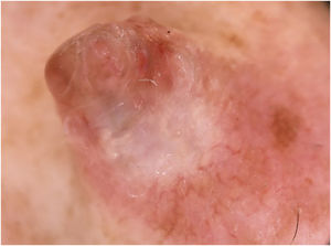 Dermoscopic image with 20× magnification. Polychromatic pattern with whitish, pink, and light brown homogeneous areas associated with linear telangiectasias.