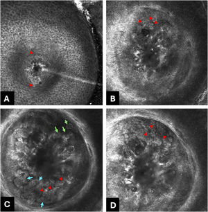 Reflectance in vivo Confocal Microscopy (RCM) individual images (500 × 500 μm) reveal: (A) Epidermal assessment; disarrangement of the honeycomb due to epidermal flattening secondary to epithelial and stromal proliferation caused by the infiltration of the pea shaped cells (red arrow heads). (B‒D) Dermo-epidermal junction and papilar dermis assessment; proliferation of “pea-shaped” atypical epithelial cells (red arrowheads) forming lobulated (light-blue arrows) and cerebriform nests (light green arrows).
