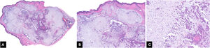 Histological (Hematoxylin & eosin) images of chondroid syringoma. (A) Hematoxylin & eosin, 20×; (B) Hematoxylin & eosin, 50×; (C) Hematoxylin & eosin, 200 × . The tumor displays a proliferation of epithelial cells within a rich chondroid and myxoid stroma. The cells are organized in cords and nests, and exhibit ovoid nuclei, small nucleoli, and pale cytoplasm. Focal keratinization is also present.