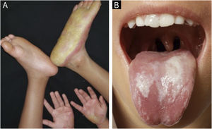 (A) Erythema, calluses and hyperkeratotic palmoplantar lesions under treatment using acitretin only. (B) Keratotic plaques around the mouth alongside leukokeratosis on the tongue using acitretin only.