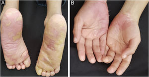(A and B) Treatment with acitretin and systemic erlotinib for 16-months reduced painful PPK and erythema.