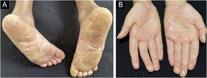 (A and B) Aspect at 46-months of the combined treatment showing reduced PPK and no erythema.