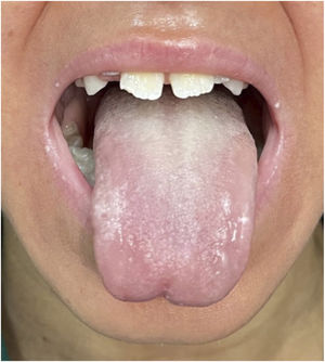 Current aspect at 52-months of treatment showing absence of keratotic plaques around the mouth and absence of leukokeratosis on the tongue.