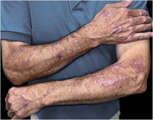 Clinical appearance of erythematous-violaceous plaques on the dorsal hands and forearms, three months after initiating durvalumab therapy and prior to starting dermatologic treatment.