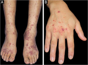 (A) Multiple purpuric maculopapular lesions extending from both the lower legs to the dorsum of the feet. (B) Palpable purpuras on the dorsum of the right hand.