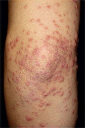 Papules in a cluster formation on the left upper extremity.