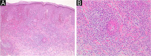 (A‒B) A biopsy taken from the lesion on the hand showing marked extravasation of red blood cells, and diffuse infiltration of inflammatory cells in the dermis and leukocytoclastic vasculitis with fibrinoid degeneration of the blood vessels in the upper to mid-dermis (Hematoxylin & eosin: A, ×100; B, ×200).