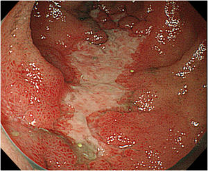 Endoscopic image: multiple geographic ulcers in the terminal ileum.
