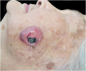 A red exophytic nodule approximately 3 × 3.5 cm on the left cheek of the patient. precisa girar esta imagem 90 graus esquerda.