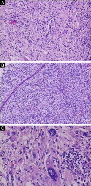 (A) Neoplastic architecture demonstrating tumoral infiltration within the dermis, composed of pleomorphic spindle cells along with multinucleated giant cells (Hematoxylin & eosin, ×200). (B) Some tumor cells are arranged in a storiform pattern (Hematoxylin & eosin, ×200). (C) Atypical cells on higher magnification (Hematoxylin & eosin, ×400).