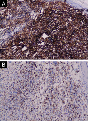 (A) Positive staining for CD10 and (B) CD68 (Hematoxylin & eosin, ×200).