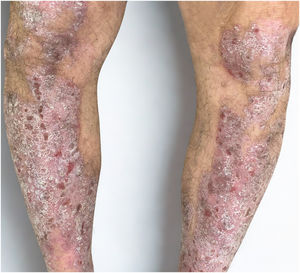 Clinical presentation before ruxolitinib initiation. Extensive erythematous plaques with thick scaling on the lower extremities. Lesions were symmetrical, infiltrated, and associated with marked desquamation (PASI 14).