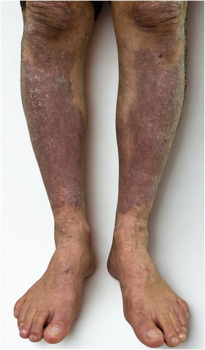 Partial clinical improvement after 30-days of therapy. Noticeable reduction in erythema, infiltration, and scaling of psoriatic lesions on the lower legs.